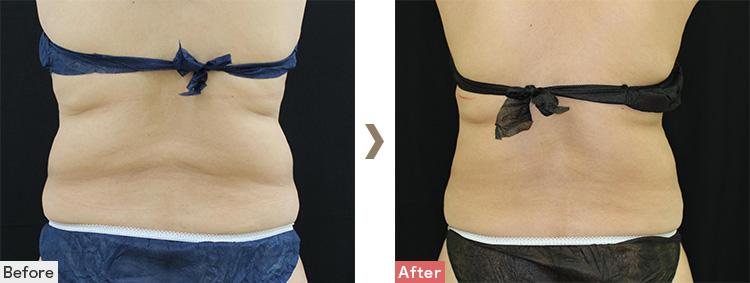 背中│リポコントラスト+クール・スカルプティング（ゼルティック）症例写真