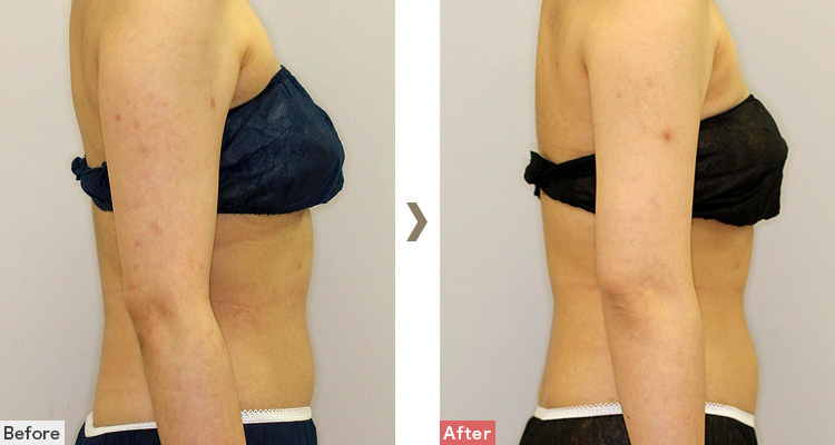 二の腕│クール・スカルプティング（ゼルティック）症例写真