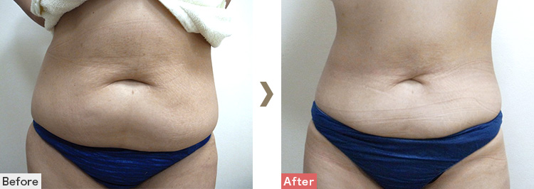 お腹│ダイエットプログラム3部位（上腹部、下腹部、側腹部）症例写真